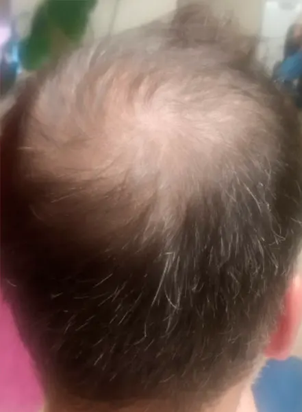 Tratamiento de crecimiento de cabello antes de indiba