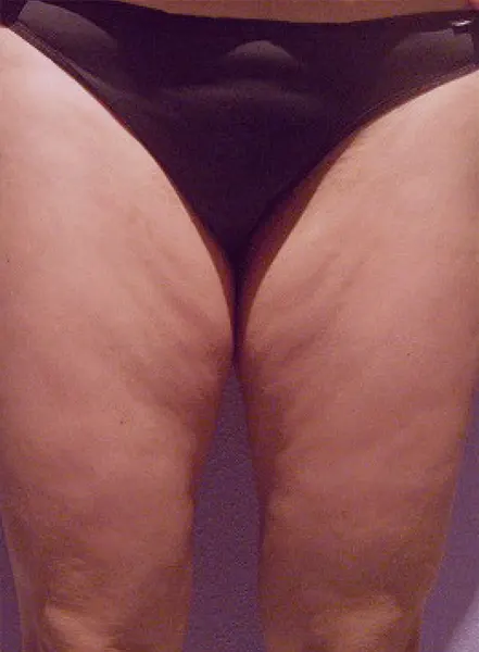 Detalle de foto de piernas antes de tratamiento con Indiba